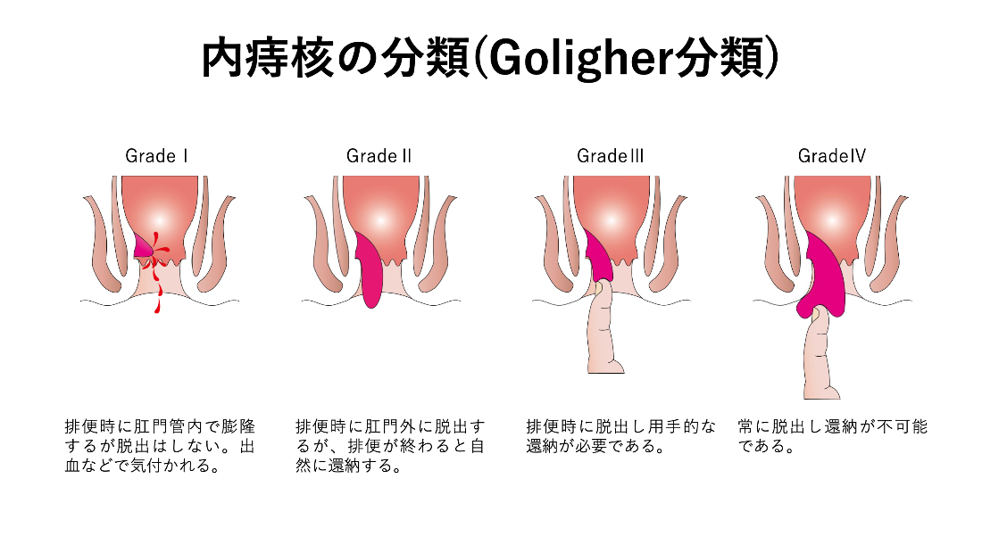 内痔核の分類_イラスト