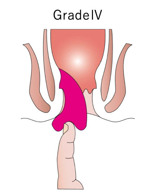 内痔核の分類_イラスト.04