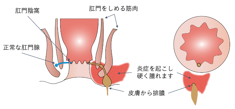 痔核_イラスト.02