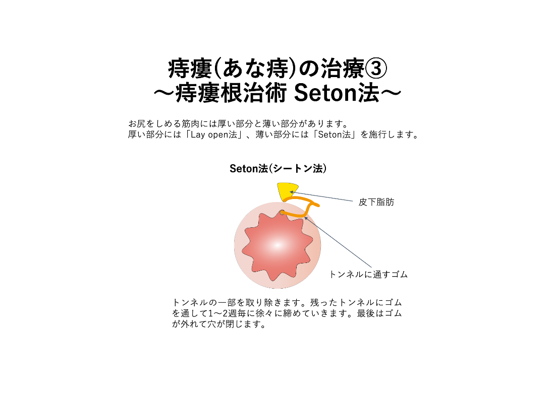 LE法＋ALTA療法_イラスト