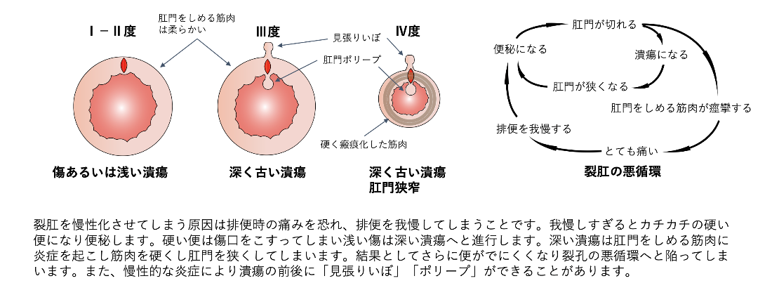 切れ痔について_イラスト