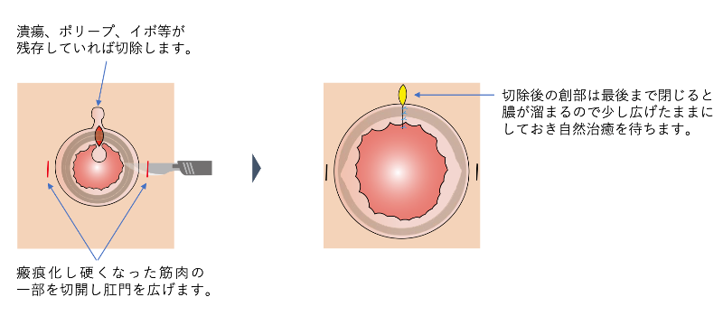 深い切れ痔の治療_イラスト.02