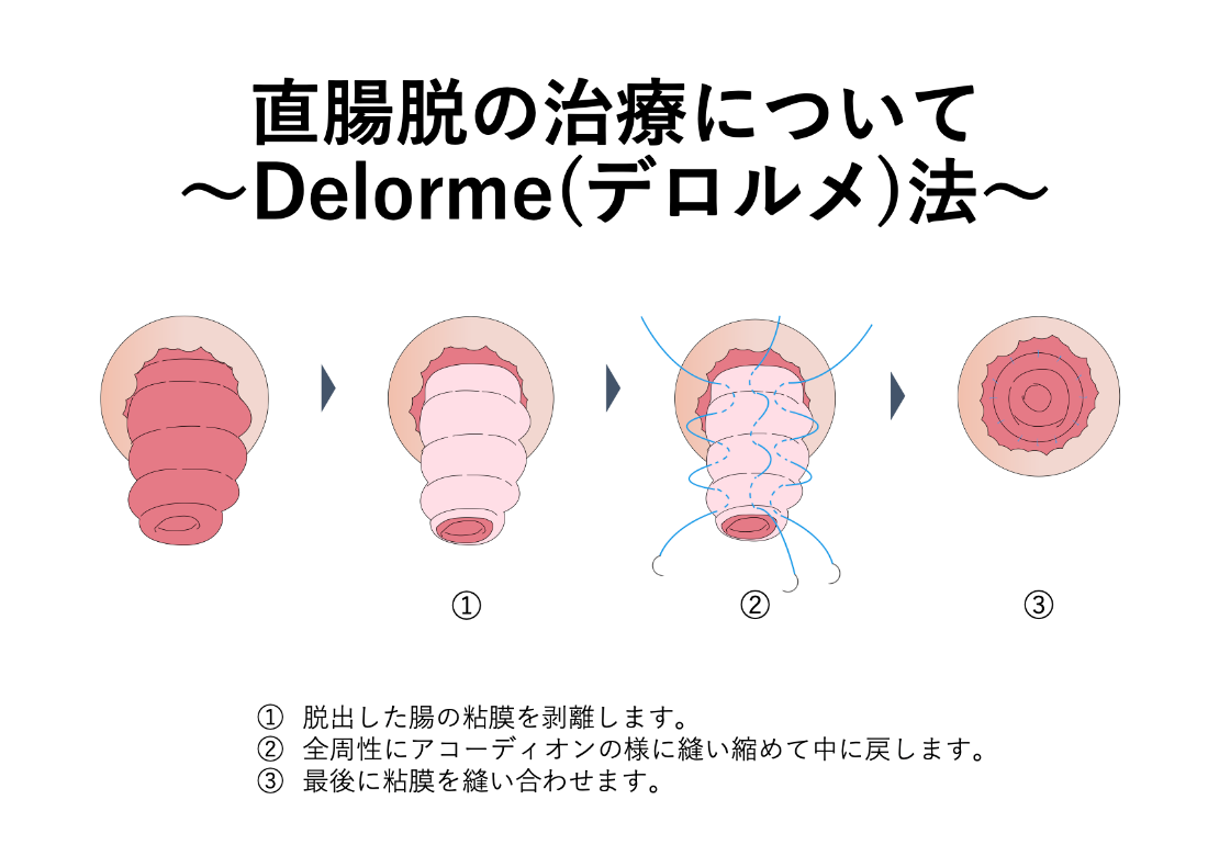 直腸脱の治療_ デロルメ法_イラスト