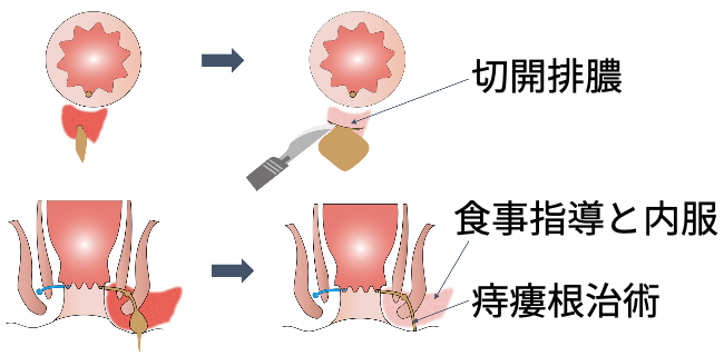 痔瘻の治療_急性期_イラスト