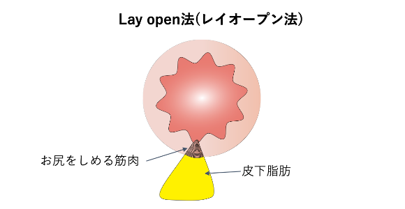 結紮切除術（LE法）_イラスト