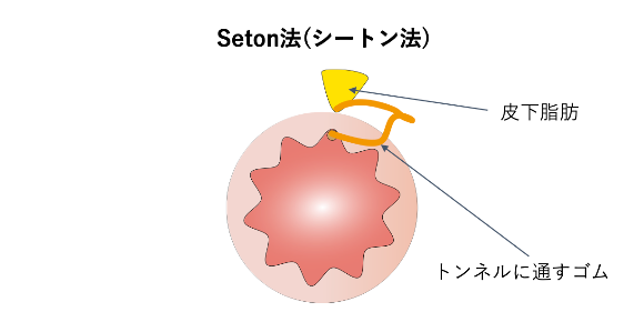 LE法＋ALTA療法_イラスト