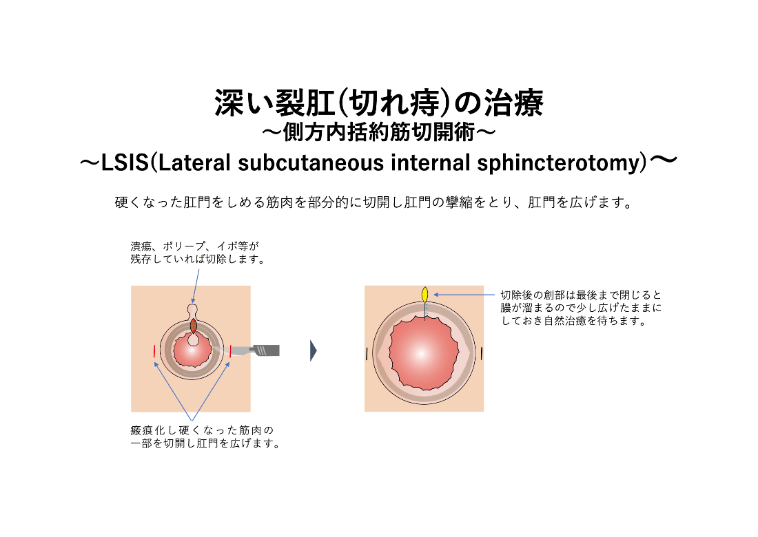 深い切れ痔の治療_イラスト.02