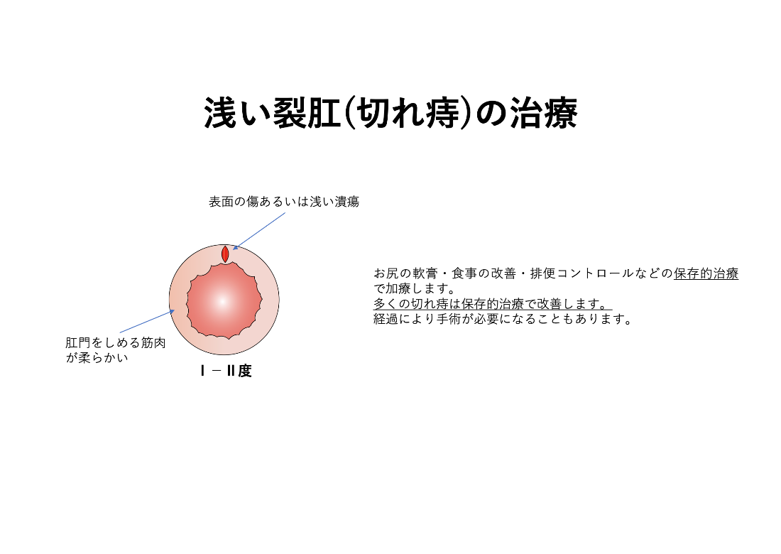 浅い切れ痔の治療_イラスト