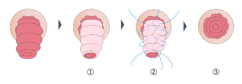 直腸脱の治療_デロルメ法_イラスト