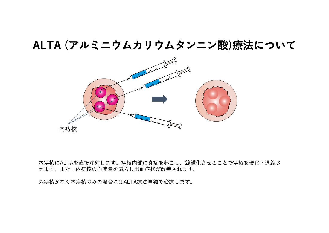 ALTA療法_イラスト