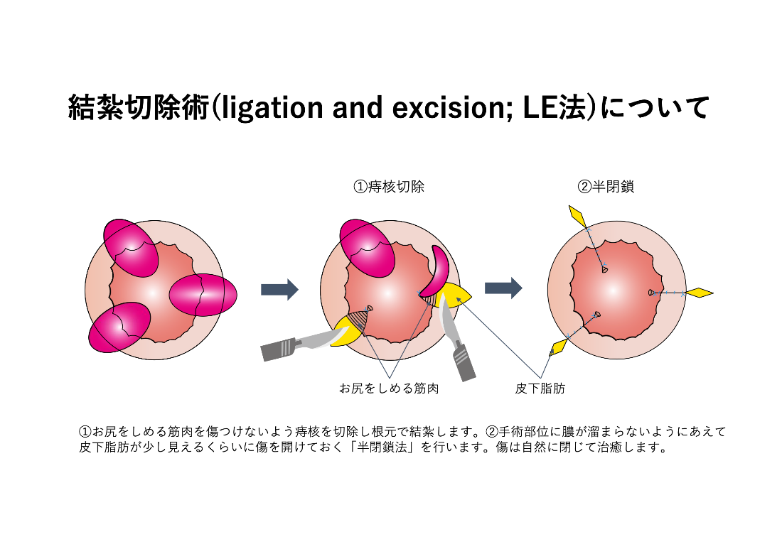 結紮切除術（LE法）_イラスト