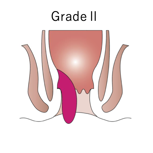 内痔核の分類_イラスト.02