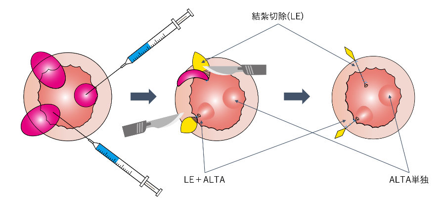 LE法＋ALTA療法_イラスト.02