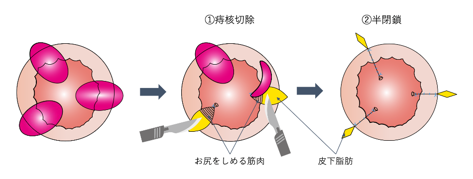 結紮切除術（LE法）_イラスト.02