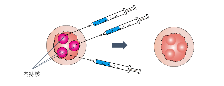 ALTA療法_イラスト.02