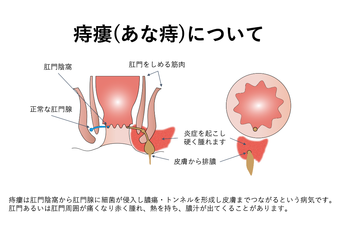 痔瘻について_イラスト