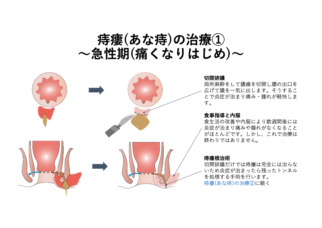 ALTA療法_イラスト