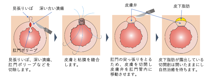 深い切れ痔の治療_イラスト.01