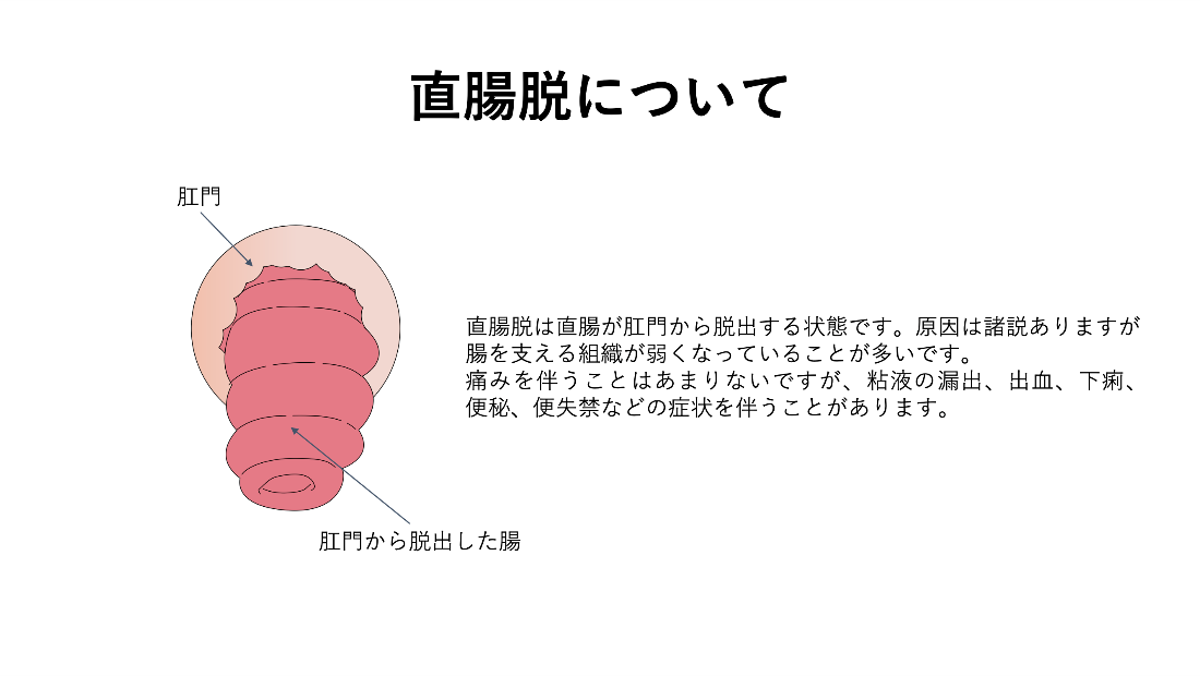 痔核について_イラスト