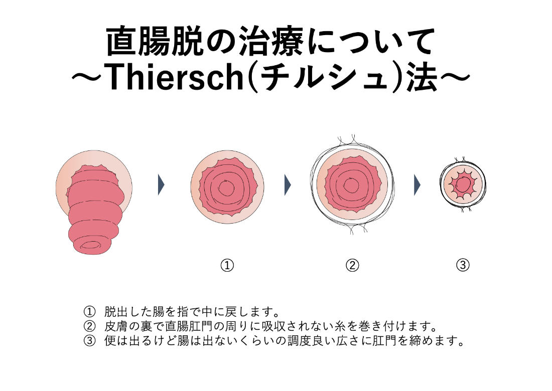 直腸脱の治療_チルシュ法_イラスト