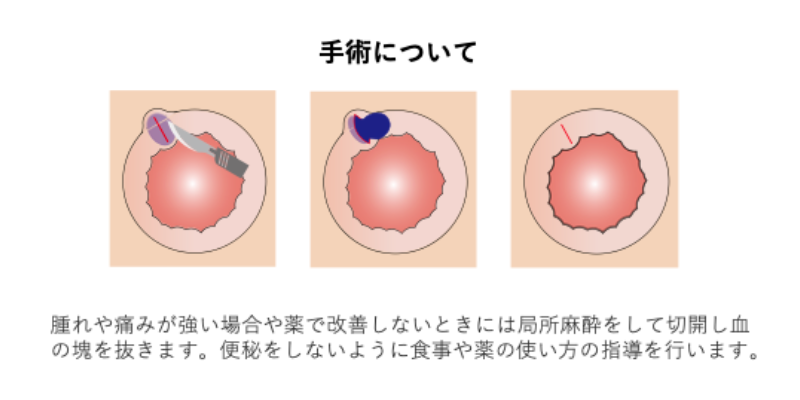 血栓性外痔核_手術_イラスト